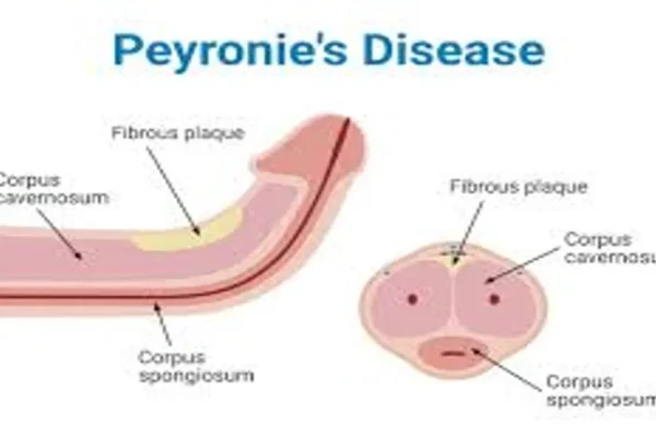 Peyronie’s Disease
