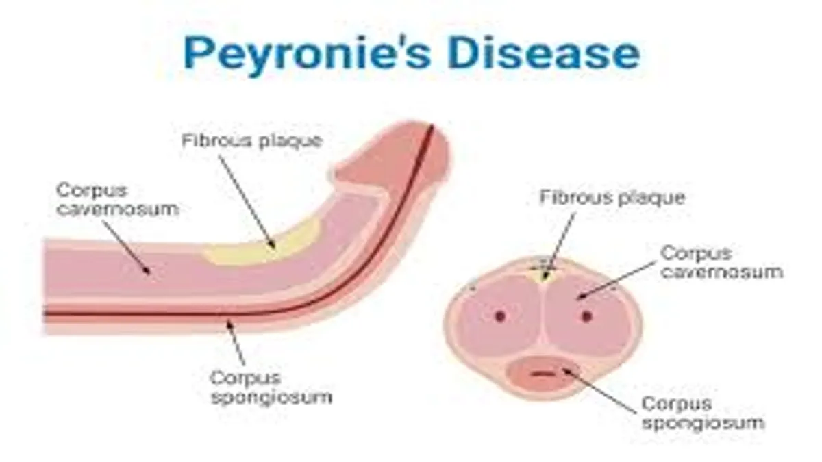 Peyronie’s Disease